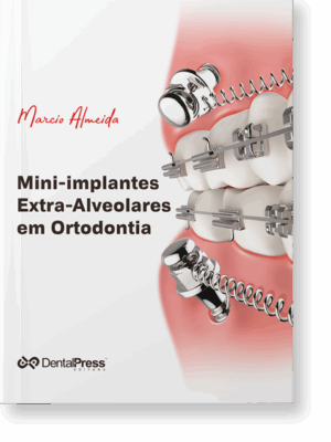 Mini-Implantes Extra-Alveolares Em Ortodontia 2a. Reimpressão/